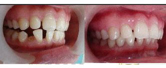 单颗牙齿缺失治疗前后对比