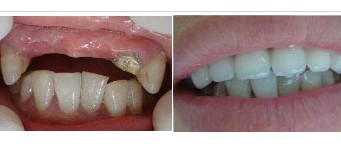 多颗牙齿缺失后治疗前后对比