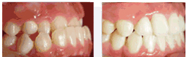 牙齿矫正前后对比图