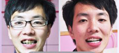 牙齿矫正前后对比图