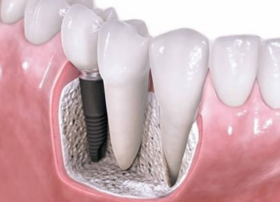 半口牙缺失最好的修复方法是什么