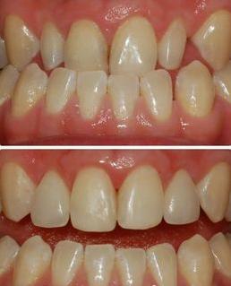 郑州牙齿正畸的价格 郑州牙齿正畸的价格