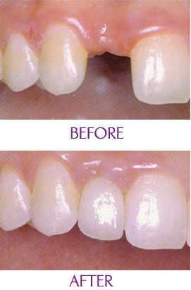 做种植牙对邻牙会有影响吗 做种植牙对邻牙会有影响吗