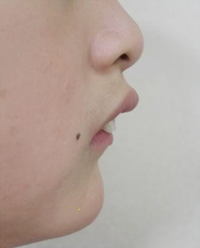 牙齿深覆合一定要矫正吗 牙齿深覆合一定要矫正吗