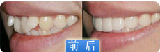 矫正牙齿费用是多少